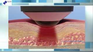 Deep Tissue Laser Therapy The Science Behind Healing [upl. by Eirrej]