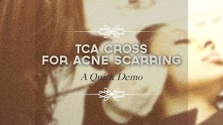 TCA CROSS FOR ACNE SCARS l Ice pick amp Boxcar scars on Asian Skin [upl. by Margo]