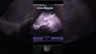 liverabscess abscess usgliver ultrasoundguided ultrasound [upl. by Kristos100]