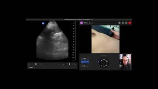 Teach the eFAST exam remotely 34  Left Upper Quadrant [upl. by Oileve]