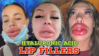 LIP INJECTIONS WITH NO NEEDLE [upl. by Anneiv]