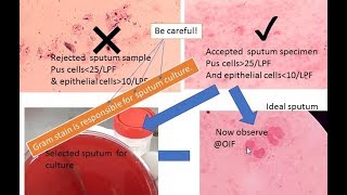 Determination of the Quality of a Sputum Specimen prior to culturing  Gram stain Ideal sputum [upl. by Abla]