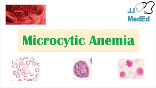 Microcytic Anemia amp Causes Iron Deficiency Thalassemia Anemia of Chronic Disease Lead Poisoning [upl. by Remled584]