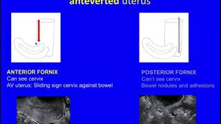 Loop biopsy for suspected endometrial cancer Hysteroscopy [upl. by Rokach]