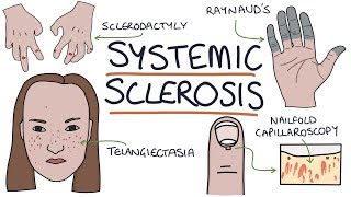 Systemic Sclerosis and Scleroderma Visual Explanation for Students [upl. by Beaston417]