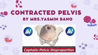 contracted pelvis and CPD [upl. by Irra]