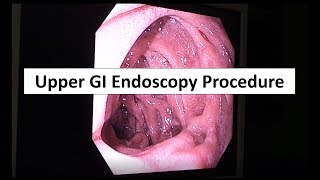 Upper GI Endoscopy Procedure in the ED [upl. by Arlo]