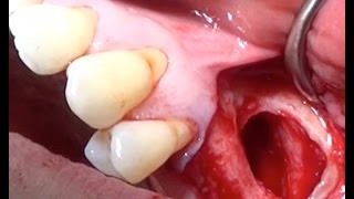 Paranasal Sinuses  2  Maxillary Sinus [upl. by Sorkin]