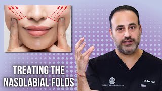 Treating the Nasolabial Folds  Lesson of the Day [upl. by Slayton]