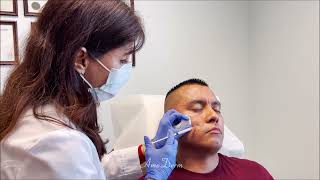 Acne Scar Treatment with Filler [upl. by Aicenod]