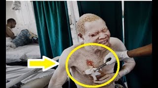 El infierno que viven los albinos en africa [upl. by Htebazileharas819]