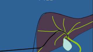 Biliary Stenting [upl. by Revolc615]