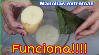 COMO QUITAR MANCHAS DE TU CARA EXTREMAS REMEDIO CASERO PARA MANCHAS [upl. by Cull829]