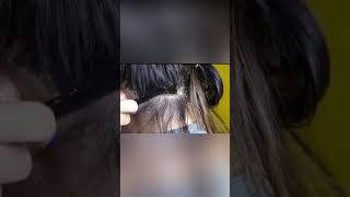 Do you still have psoriasis dandruff  Psoriasis  dandruff dandruff psoriasis hair [upl. by Gustavo]