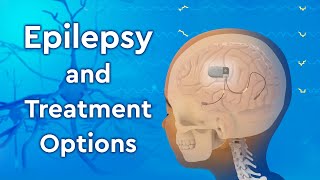 What is Epilepsy and How is it Treated [upl. by Alliber949]