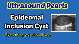 Ultrasound Pearls Epidermal inclusion cyst [upl. by Towne877]