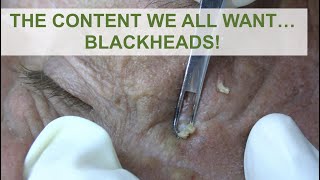 The content we all wantBlackheads  Dr Derm [upl. by Attirb]