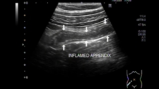 Ultrasound Video showing Focusing of Acute Appendicitis [upl. by Ormsby]