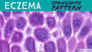 EczemaAtopic Contact Dermatitis etc Spongiotic Dermatitis Pattern  Inflammatory Dermpath Basics [upl. by Joses]