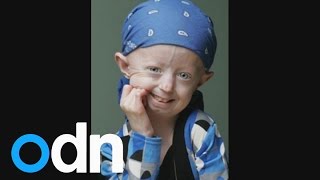 Britains oldest teenager dies Tributes to Progeria campaigner Hayley Okines [upl. by Assiluj]