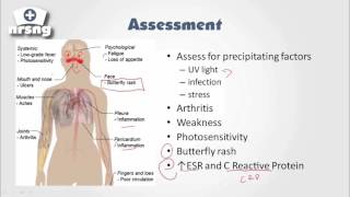 Lupus SLE NCLEX® Review  NRSNGacademycom [upl. by Brenner]