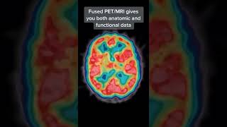 Nuclear medicine gives use beautiful images of brain function [upl. by Amilas628]