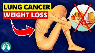 Unexplained Weight Loss  Lung Cancer  Cachexia [upl. by Llehsyt]