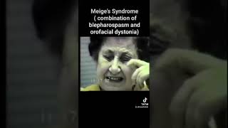 meige s syndrome combination of blepharospasm and orofacial dystonia [upl. by Justine]