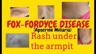 FOXFORDYCE DISEASE or and rashsunder armpit over breastDermatology lecture for MBBS [upl. by Nama]