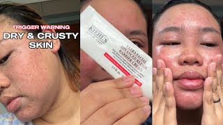 Kiehl’s Ultra Facial Advanced Repair Barrier Cream on dry flaky eczema sensitive skin [upl. by Haliled]