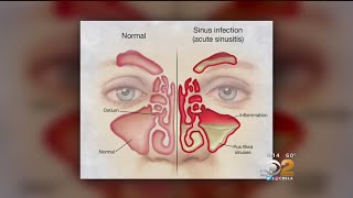 Doctor Tried And True Methods For Sinus Relief Are Still Best [upl. by Assinna]