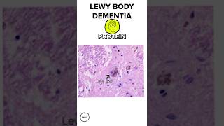 What is Lewy Body Dementia 🧠 [upl. by Nohtanhoj]