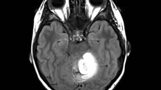 Pilocytic Astrocytoma [upl. by Moshell821]