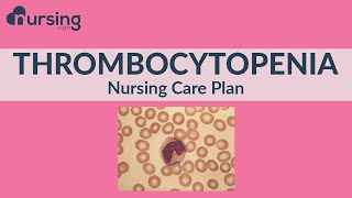 Nursing Care Plan for Thrombocytopenia Nursing Care Plan Tutorial [upl. by Dranrev]