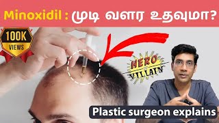 முடி வளர்ச்சிக்கு மினாக்ஸிடில் எப்படி பயன்படுத்துவது Minoxidil  Hair Loss clinic coimbatore [upl. by Dylan]