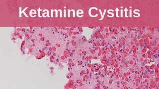 Ketamine Cystitis  Pathology mini tutorial [upl. by Ydorb]