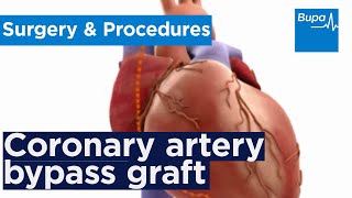 How coronary artery bypass graft CABG surgery is carried out  Bupa Health [upl. by Nosbig]