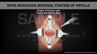 Open Reduction Internal Fixation of Patella [upl. by Anilesor]