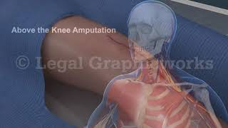 CIRURGIA DE AMPUTAÇÃO DA PERNA  3D ANIMAÇÃO [upl. by Feliks604]