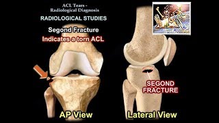 The Popliteal Artery branches amp genicular anastomosis [upl. by Gellman]