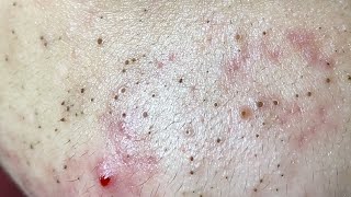 Acne Treatment Huong Da Nang The video has been lost for a long time Remove Blackheads [upl. by Mortie]