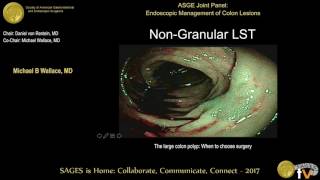 The large polyp When to choose EMR ESD surgery [upl. by Adniled981]