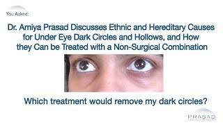 How Under Eye Dark Circles and Hollows Can Now be Treated with a Combination of Fillers and PRP [upl. by Idnic624]