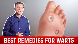 How To Remove Plantar Warts Understanding Treating and Preventing Foot Warts skinaaclinic [upl. by Goldia362]