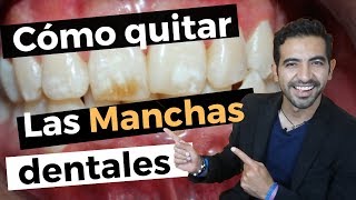 Así elimino las manchas en los dientes CASO DE ÉXITO [upl. by Meletius925]