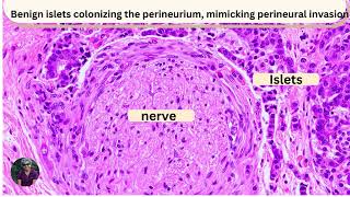 Pitfalls in GI pathology Pancreas [upl. by Isej88]