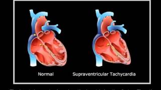 Supraventricular tachycardia [upl. by Rustie]