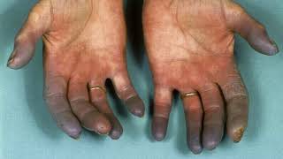 Difference Between Raynaud’s Disease and Buerger’s Disease [upl. by Naugal]