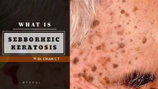 What is Seborrheic Keratosis  Dr Chiam Chiak Teng [upl. by Siskind742]