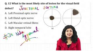 Junctional Scotoma  Dr Niha Aggarwal [upl. by Euqinotna]